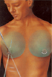 Liposuction area